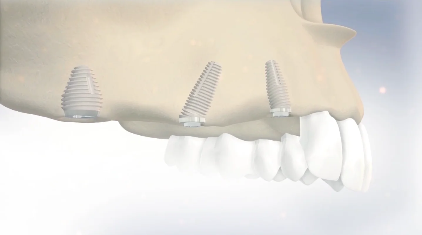Implanturi Co-Axis® Southern: soluția inovatoare pentru cazurile cu anatomie complexă